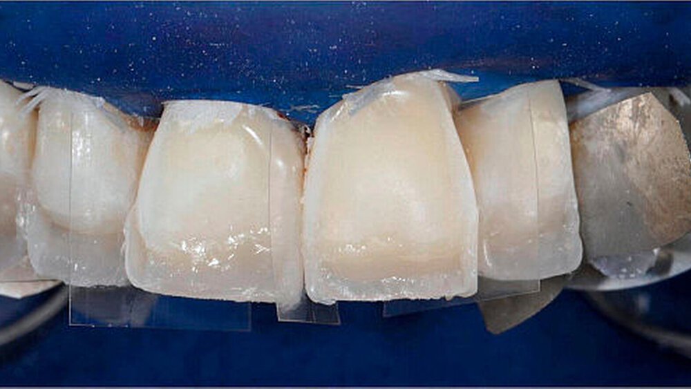 Abbildung 8: Fertiggestellte approximale Randleisten aus Schmelzmasse |