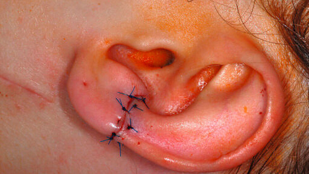 Abbildung 5: Postoperatives Bild nach Keilresektion des malignen Melanoms |