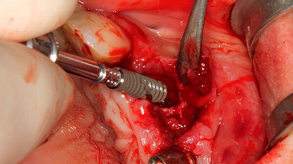 Insertion des BLX-Implantats in die frische Extraktionsalveole nach Präparation des Implantatbetts in palatinaler Position