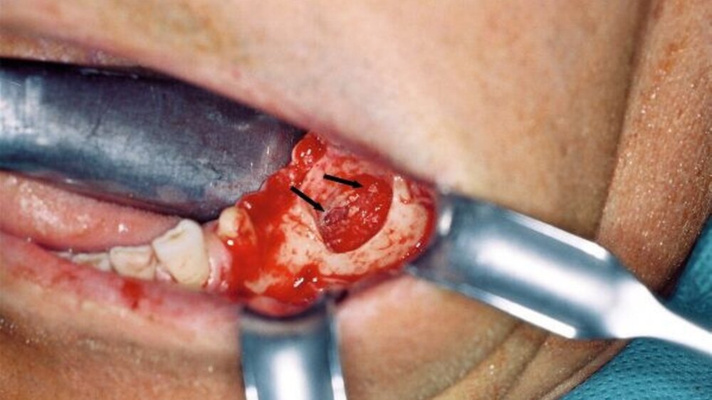 Abbildung 1: Klinischer Befund nach erfolgter Osteotomie des Zahnes 36 und anschließender schonenden Freilegung des Nervus alveolaris inferior. Neben der Diastase der Nervenendigungen (Pfeile) zeigt sich eine starke traumatische Schädigung des Nervens.
