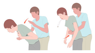 Techniken bei Obstruktionen der Atemwege durch Fremdkörper