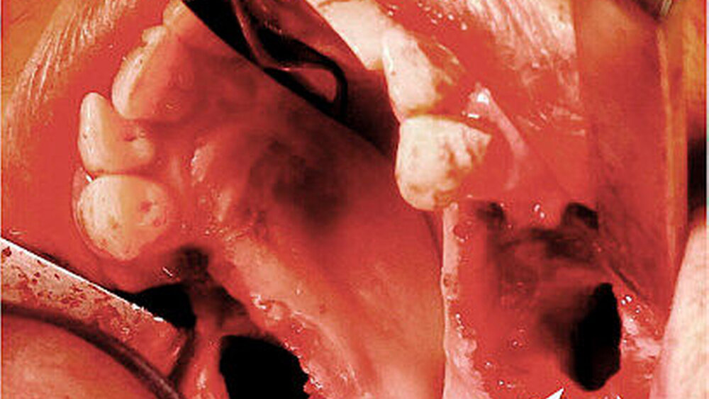 Abbildung 3: Intraoperative Situation nach Resektion des nekrotischen Knochens mit großflächiger MAV (weiße Pfeile) vor der plastischen Deckung |