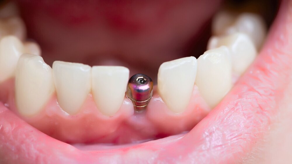 single tooth implant Zahnimplantat