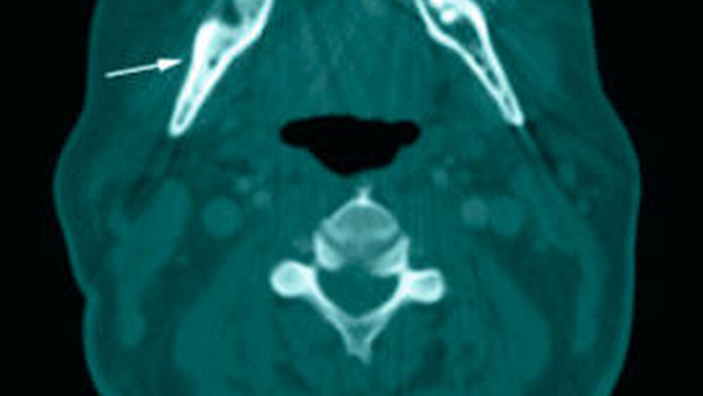 Abbildungen 2a bis 2c: Axiale Schichten aus der Computertomografie nach Abszessspaltung, im Weichteilfenster (a) mit noch nachweisbarem Verhalt im Bereich des Processus muscularis (Pfeile), im Bereich des aufsteigenden Unterkiefer-Astes (b) und im Unterkieferkorpus (c), beide im Knochenfenster: Deutlich zu erkennen sind die alterierte Knochenstruktur mit sklerotischen Veränderungen (besonders in c) und größere Osteolysen (b).(Nebenbefundlich eine Schleimhautschwellung in der linken Kieferhöhle) |