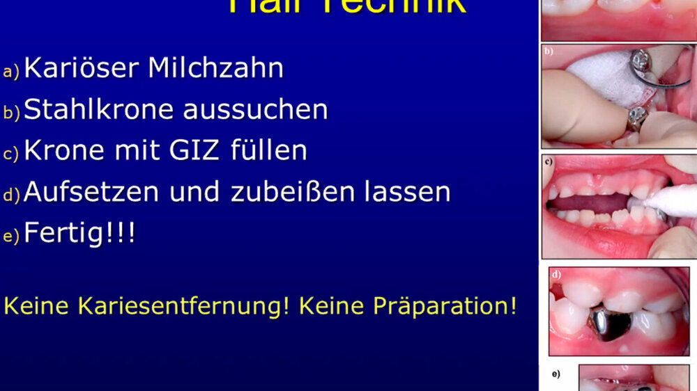 Für das Thema Kinderzahnheilkunde war Prof. Dr. Christian Splieth aus Greifswald zugeschaltet. Splieth gab ein aktuelles Update zu den Entwicklungen in der Kinderzahnheilkunde: „Die Stahlkrone funktioniert besser als Füllungen.“, erklärte Splieth.