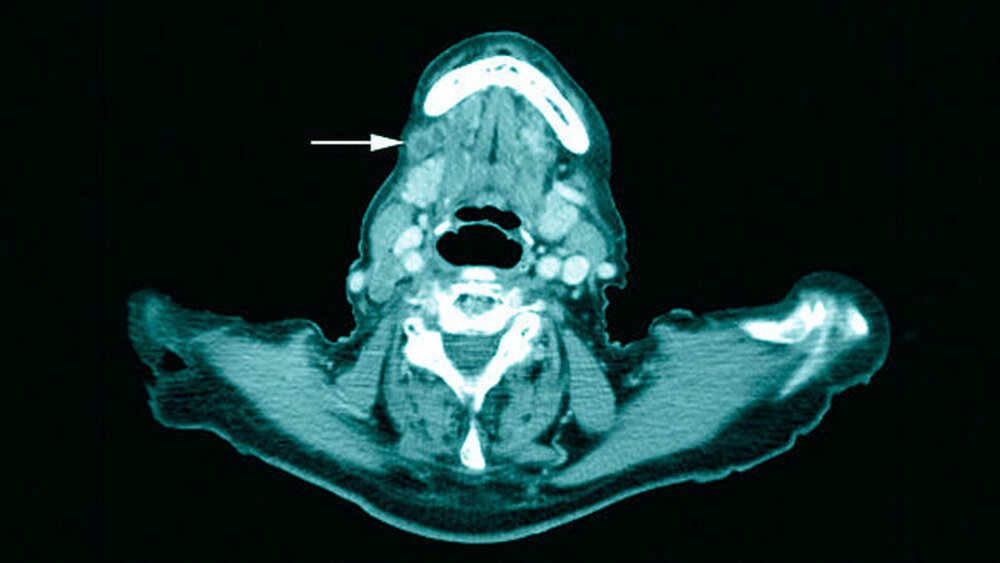Abbildung 7: Computertomografie wenige Wochen nach Abschluss der Radiatio mit höchstgradigem Metastasenverdacht (Pfeil) |