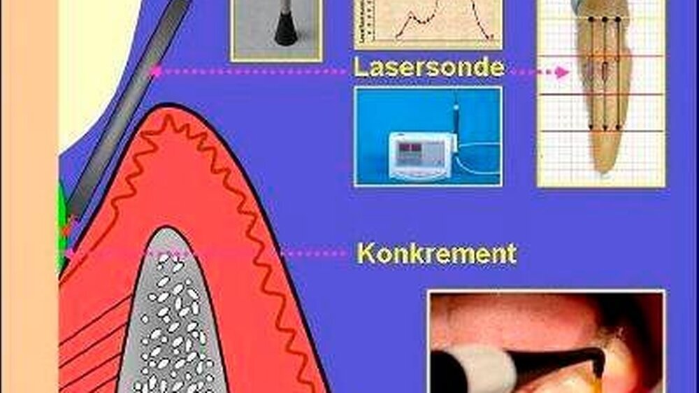 Abb. 1: Entwicklung einer „Lasersonde“ zur Detektion subgingivaler Konkremente auf der Basis des DIAGNOdent ®-Systems.