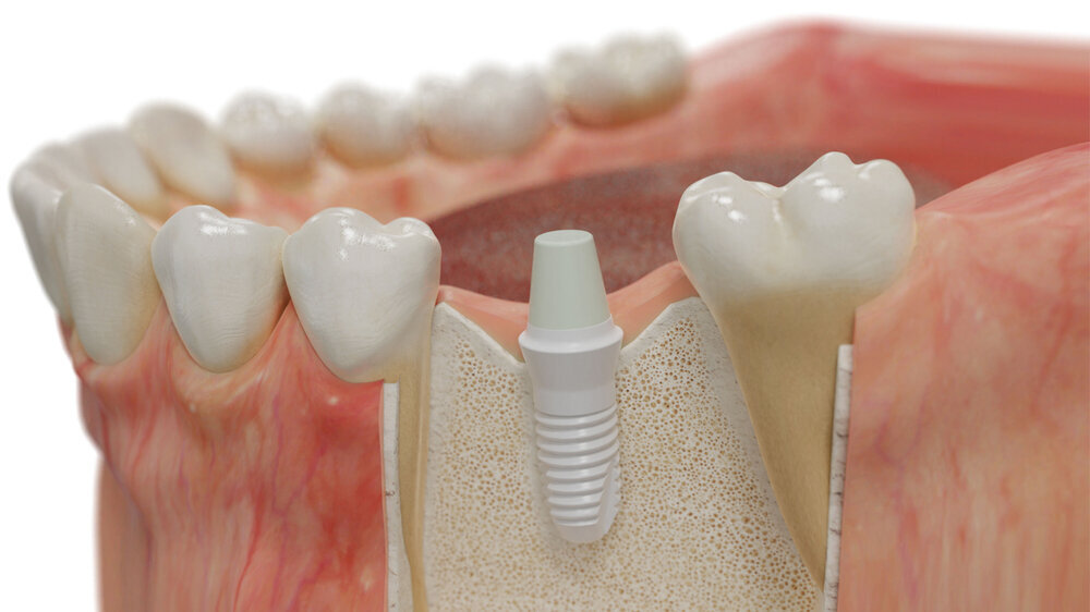 Inseriertes Keramik Implantat im Kieferknochen Inseriertes Keramik Implantat im Kieferknochen