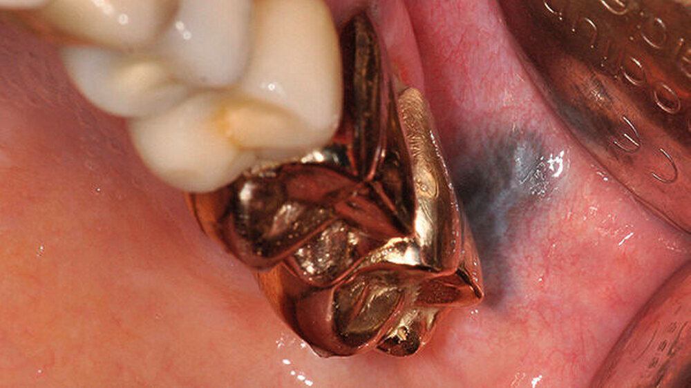 Abbildung 1: Schwarz-bläuliche Pigmentierung distal des mit einer Goldkrone versorgten Zahns 27 im Bereich der Umschlagfalte