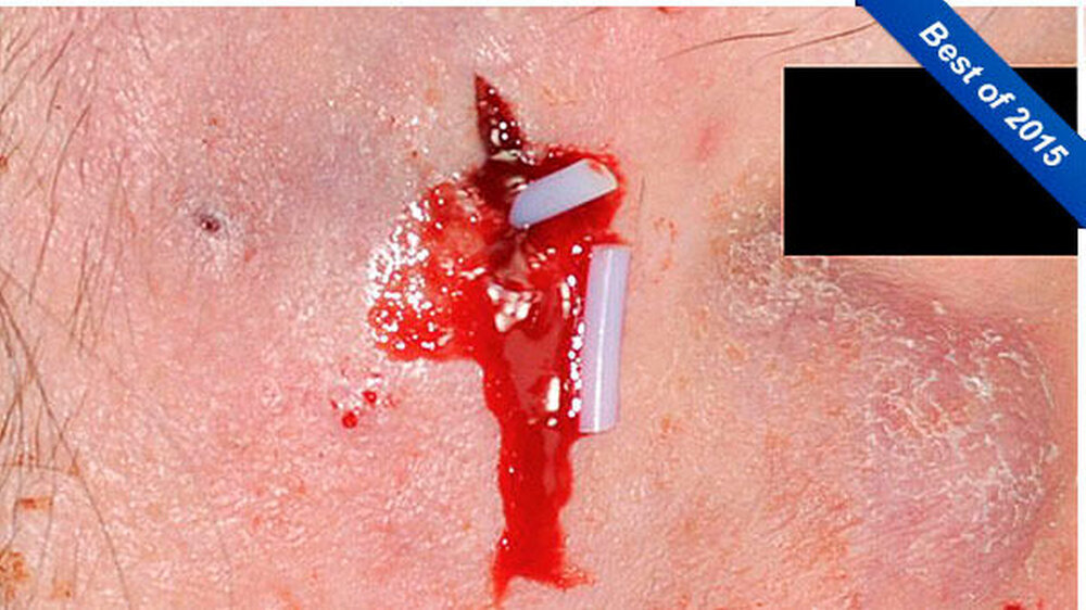 Abbildung 1: Deutliche Schwellung infraorbital: Abgang multipler subdermaler Implantate über die latero-orbital aufgeweitete Fistel.(Der Patient hatte sich, weil er mit seinem Aussehen nicht zufrieden war, Stäbchen implantieren lassen, damit sie die Hau