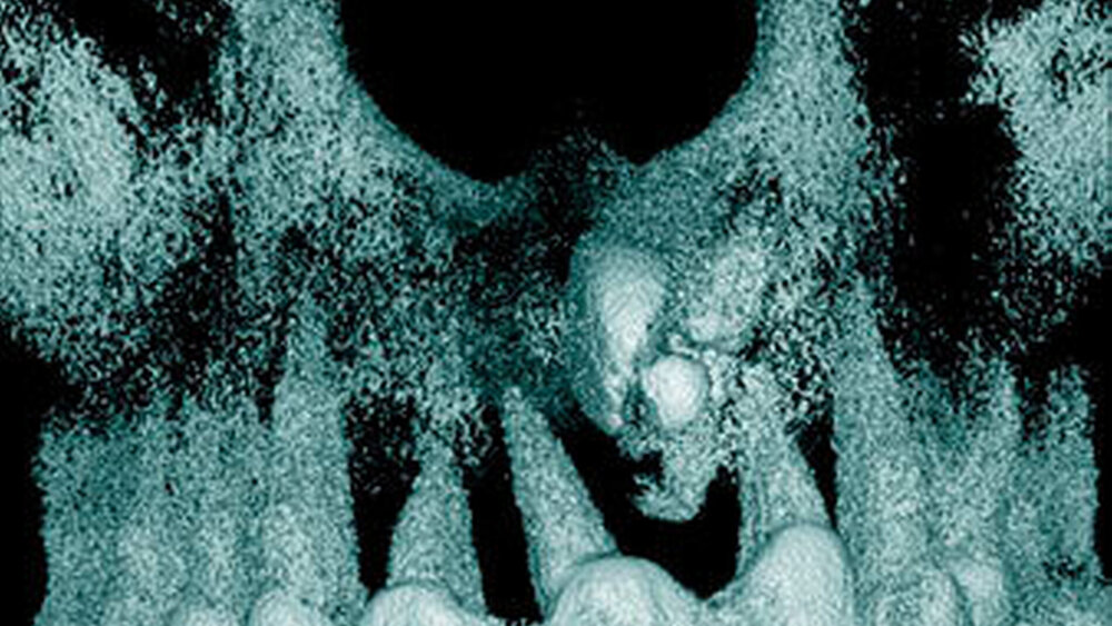 Abbildung 12: Überzähliger Zahn im Oberkieferfrontbereich (21+) mit einer konischen Form sowie ein zusammengesetztes Odontom disto-kaudal dieses überzähligen Zahnes bei einem 14-jährigen Knaben (d: 3-dimensionale Bildrekonstruktion). |