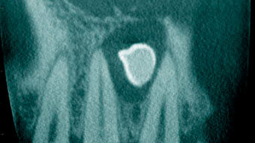 Abbildung 19: Überzähliger Zahn im Oberkieferfrontbereich (21+) mit zystischer Erweiterung des Zahnsäckchens und radiologisch erkennbarer Resorption der mesialen Wurzel von 11 bei einem 46-jährigen Patienten (a: koronales Schnittbild der digitalen Volumentomographie). |