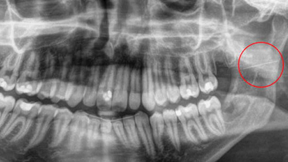 Nach erfolgreicher Osteotomie des linken unteren Weisheitszahns imponierte in der postoperativen Röntgenkontrolle ein circa 2,5 cm langer metallischer Fremdkörper im Bereich des aufsteigenden Unterkieferastes links