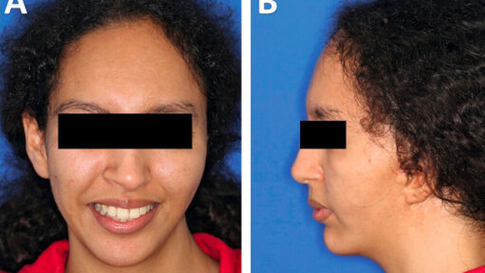 Abbildung 5: Postoperatives Ergebnis von frontal (A) und von links sagittal (B) |