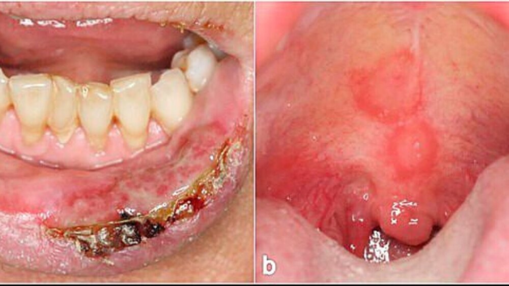 Abbildung 11: a: Bei einer ausgeprägten Herpes-simplex-Virus-Infektion können schmerzhafte Erosionen an der Mund- und Lippenschleimhaut auftreten. b: Das Erythema exsudativum multiforme präsentiert sich häufig ebenfalls mit Erosionen der Mundschleimhaut. |