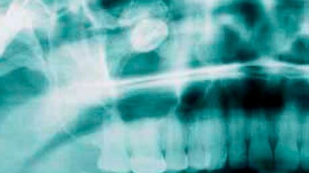 Abbildung 1: Ausschnitt Orthopantomogramm: Hoch in der Kieferhöhle, bereits in Projektion auf den Orbitaboden, findet sich der verlagerte Weisheitszahn. Diagnostisch richtungsweisend ist der umgebende Saum eines inhomogen röntgendichten Gewebes mit peri
