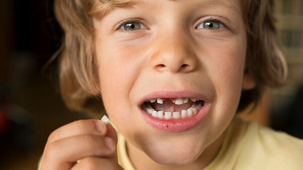 Schon seit einiger Zeit werden als mögliche Auslöser von Autismus Metalle diskutiert. Die Milchzähne sind ein „Archiv“ für die Metall-Exposition in der frühen Kindheit. So verrät der Ort der Ablagerung im Dentin, in welchem Alter die Kinder eine