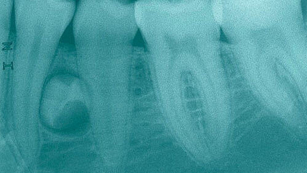 Abbildung 4: Überzählige Prämolarenzahnkeime 34+ und 44+ bei einer 16-jährigen Patientin. Bei Weiterentwicklung der Zähne besteht die Gefahr einer Wurzelresorption an den Nachbarzähnen. Mit fortschreitender Entwicklung der Zahnkeime steigt zudem das Risiko neurovaskulärer Komplikationen bei Entfernung des Zahnes, da die Wurzelbildung bei 34+ und 44+ in Richtung Foramen mentale fortschreitet. 4a: Einzelzahnröntgenbild der Regio 34 bis 37. |
