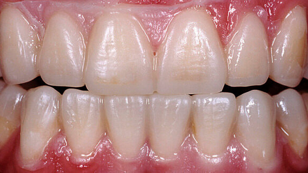 Abbildung 3: Für das Mock-up auf OK- und UK-Zähnen wurde zur ästhetischen Evaluierung eine vom Wax-up abgeleitete Schablone (Tiefziehfolie) mit Komposit (flowable) gefüllt und reversibel auf die mit flüssiger Vaseline isolierten Zähne gesetzt. |