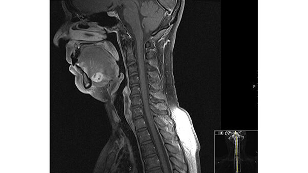 Abbildung 1: Magnetresonanztomografie im sagittalen Schnitt: Oberhalb des Musculus mylohyoideus ist eine kugelige Raumforderung mit inhomogener Binnentextur zu erkennen.