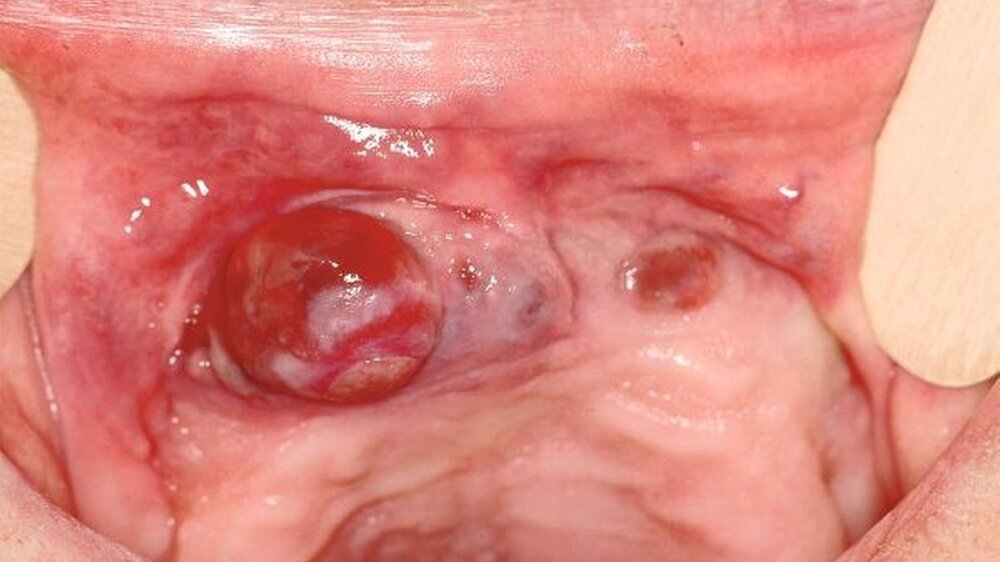 Abbildung 1: intraoraler Befund der knotigen und exophytisch wachsenden\r\nVeränderung im Bereich der medianen Maxilla von regio 13 bis 23\r\nreichend