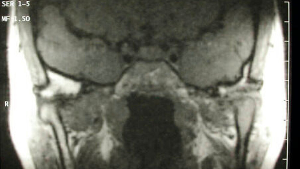 Abbildungen 1a bis 1d: Fallbeispiel Osteoarthrose: \r\nFallbeispiel Osteoarthrose: a) wegen therapierefraktärer Beschwerden extern angefertigte MRT in koronarer und