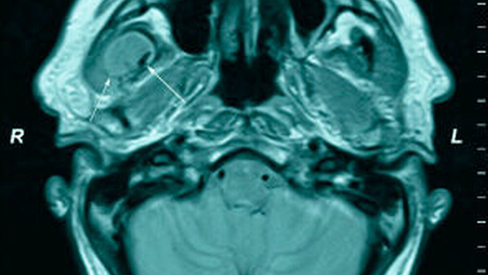 Abbildungen 1a und 1b: MRT vor Abszessspaltung alio loco in axialer (a) und in coronarer Schichtung (b) in T1-Wichtung (a) und in T2-Wichtung (b): Zu erkennen ist der Abszess mit perifokalem Ödem, dargestellt durch die Pfeile. |