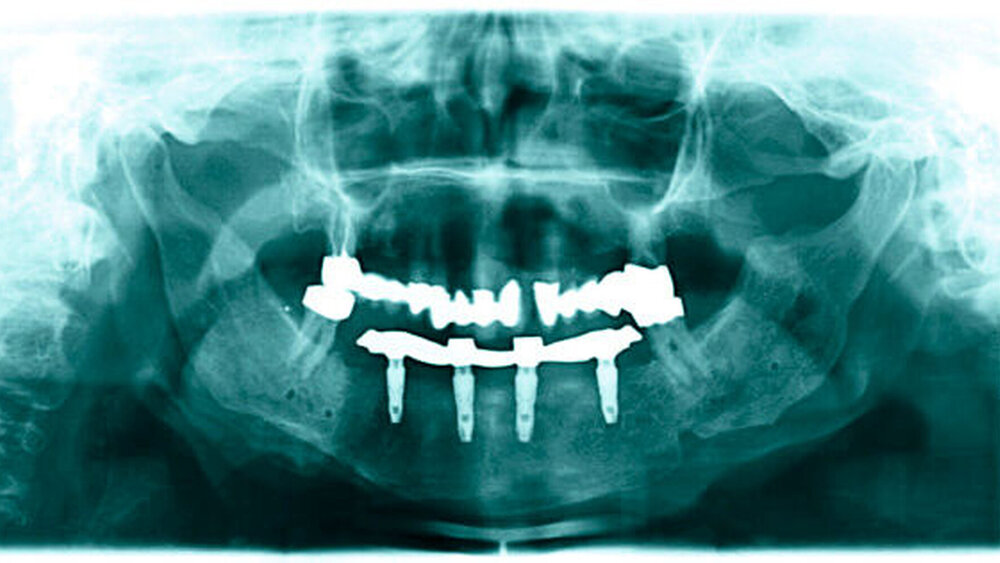 Abbildung 4: Panoramaschichtaufnahme nach Rekonstruktion des Unterkiefers mit mikrochirurgisch revaskularisiertem Beckenkammtransplantat und implantatgetragener prothetischer Versorgung |