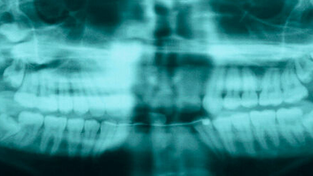 Abbildung 1: konventionelles Orthopantomogramm des Hauszahnarztes\r\n