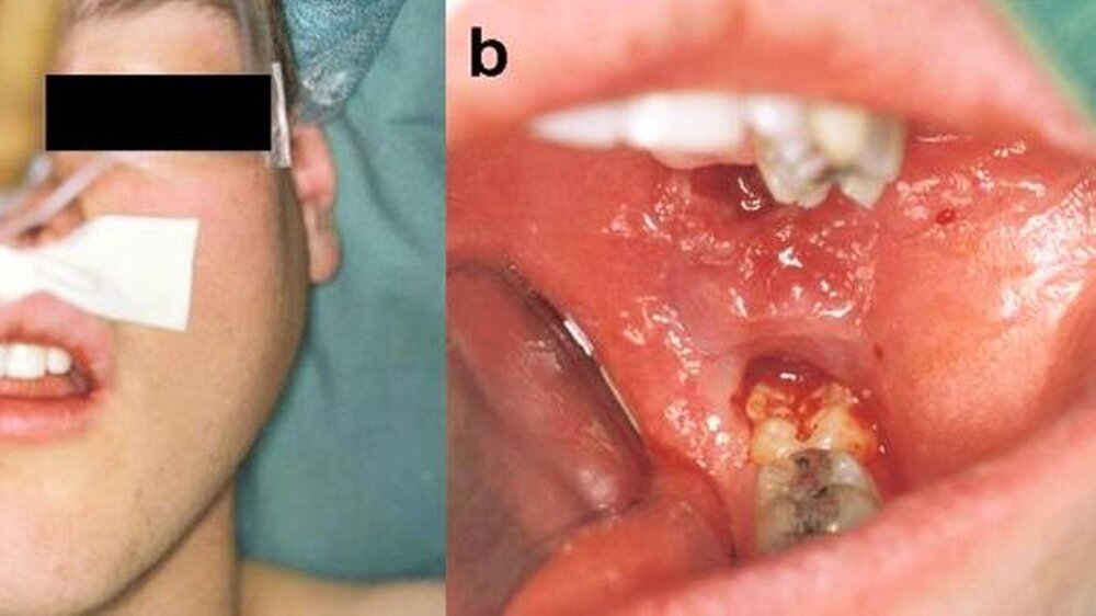 Abbildung 1: klinischer Befund präoperativ: a extraoral: deutliche Schwellung im Bereich der linken Wange. b intraoral: Ramusauftreibung retromolar