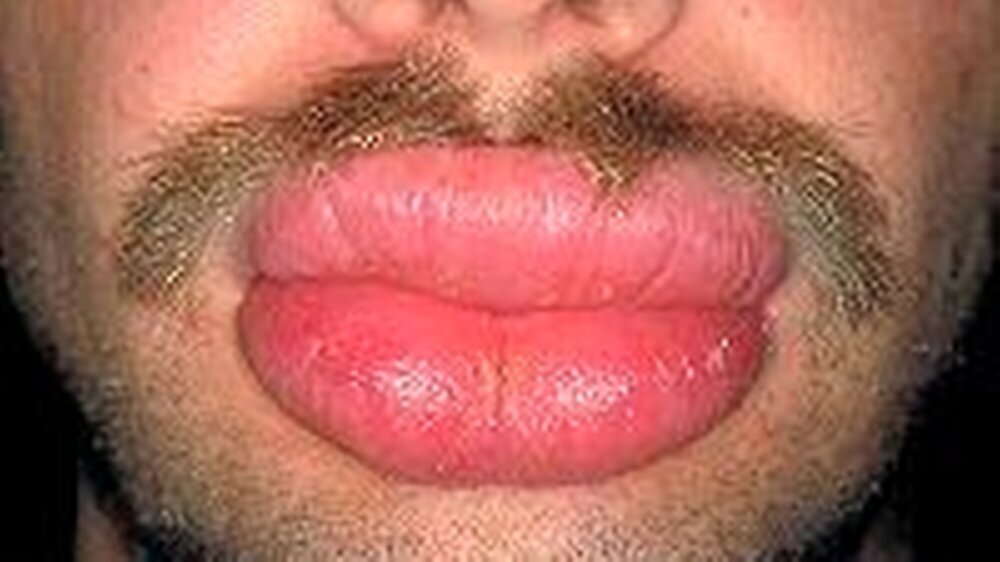 Cheilitis granulomatosa ... Wenn der Körper ungewollt eine „dicke Lippe” riskiert ...