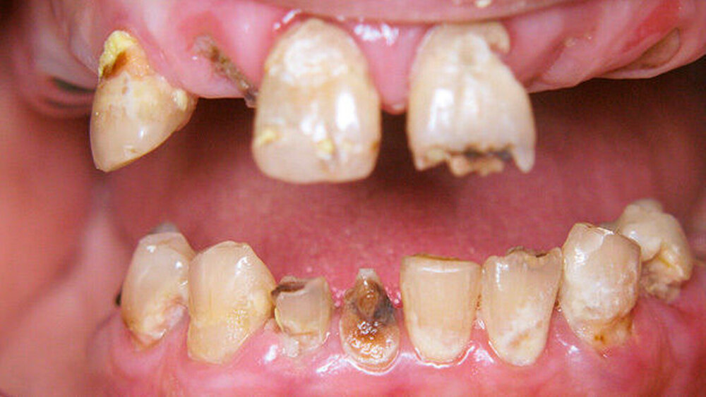 Sind Zähne vorhanden, gibt es viele Probleme: Für den aufsuchenden Behandler stellt sich regelmäßig die Frage nach der individuell geeigneten Therapie. |