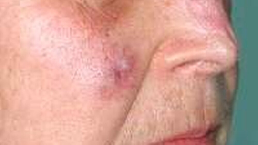 Abb. 1: Merkelzellkarzinom mit knotiger Hautformation und glatter Oberfläche, sowie radiärer rot-violetter Gefäßzeichnung (Teleangiektasie)