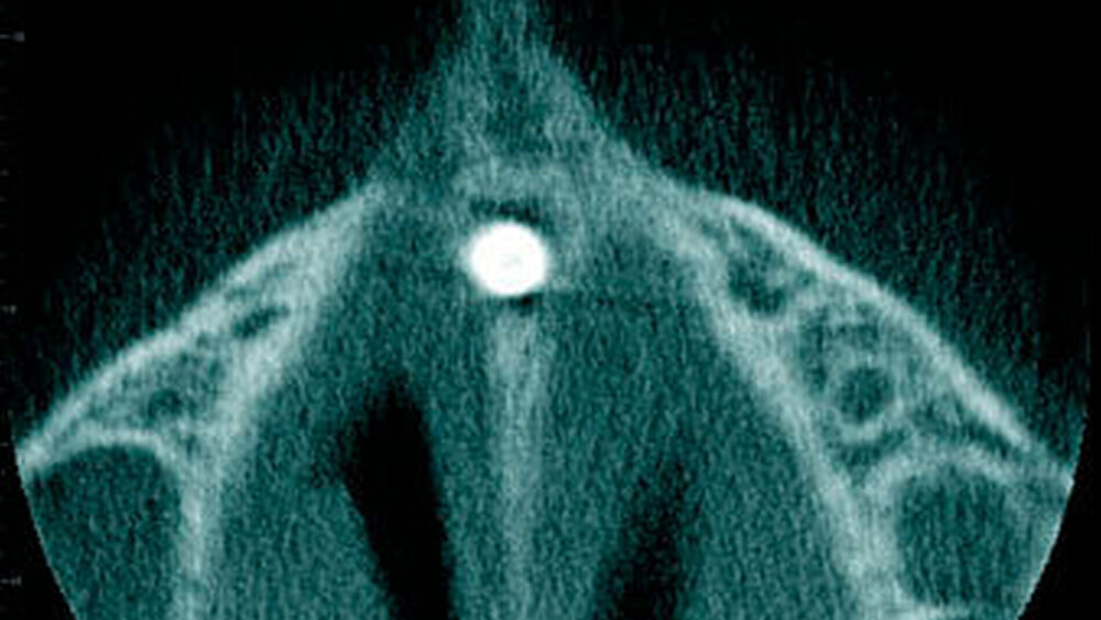 Abbildung 20: Überzähliger Zahn im Oberkieferfrontbereich (Mesiodens) mit einer konischen Form bei einem elfjährigen Mädchen mit Durchbruch in die Nasenhöhle (c: axialer Schnitt). |
