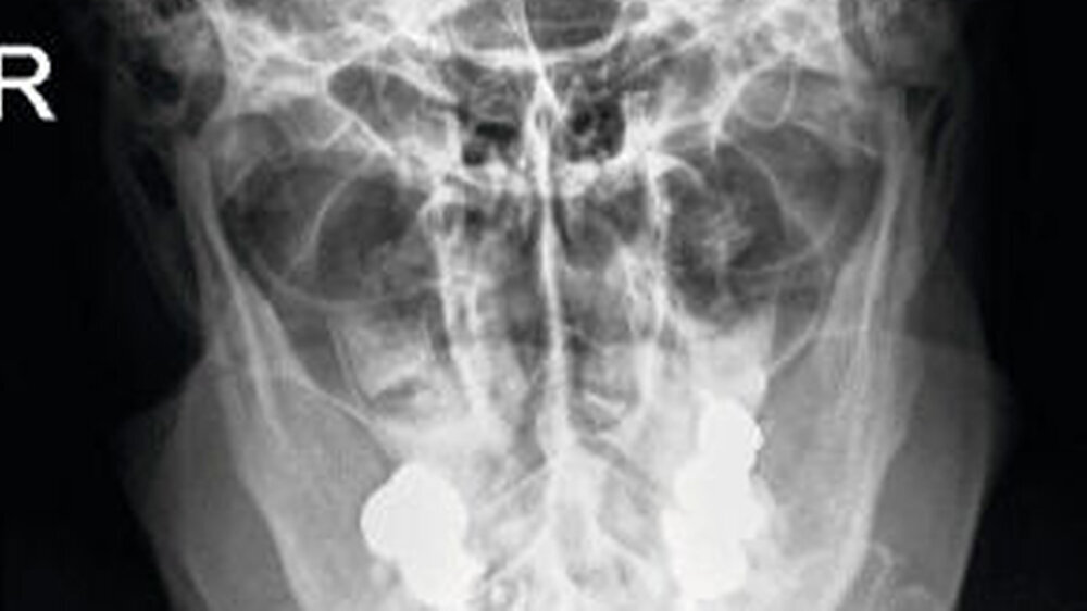 Abbildung 1: Transkraniale, posterior-anteriore Schädelübersichtsaufnahme bei einem Patienten mit beidseitiger Collumfraktur: Die beiden Gelenkköpfe sind nach anterior-medial disloziert und überlagert dargestellt. In Abbildung 5 ist das DVT der rechte