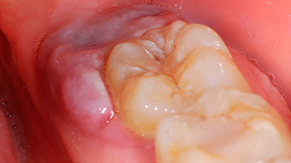 Abbildung 1: Rötlich-graue Raumforderung distal des vitalen Zahns 37 mit Impression des antagonistischen Zahns 28