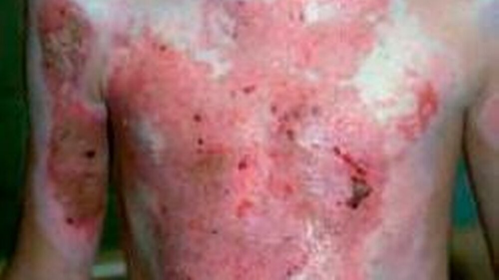 Verbrühungen bei Kindern sind nicht nur schmerzhaft, sondern hinterlassen häufig auch ein Trauma.
