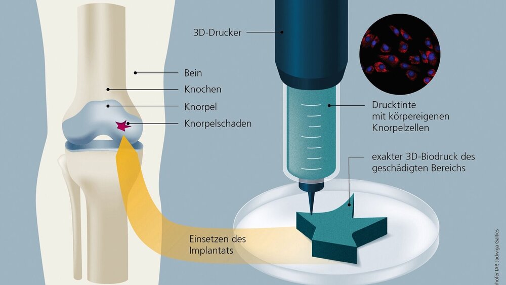 3-D-Biodruck von Knorpelgewebe