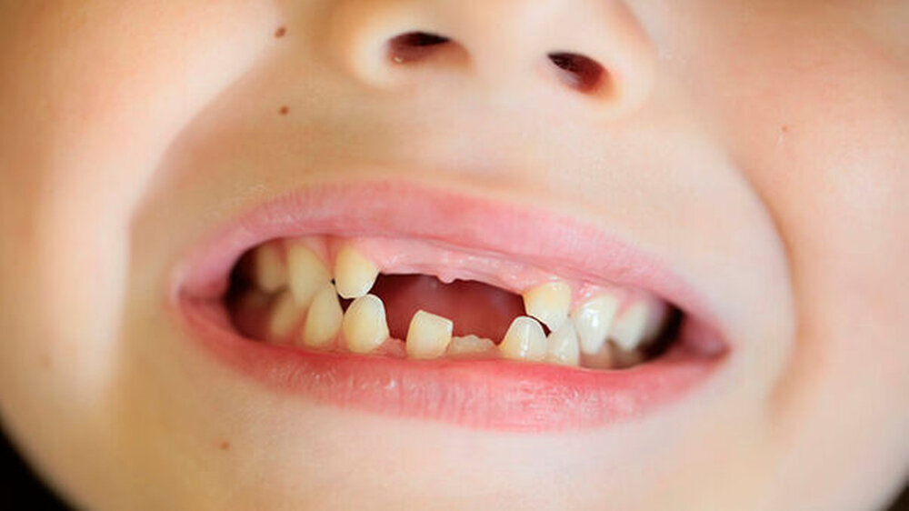 Schmelzkaries an Milchzähnen: Im Unterschied zu dem belegten prophylaktischen Nutzen ist die therapeutische Wirksamkeit von Fluoridlacken laut IQWiG weiterhin unklar.