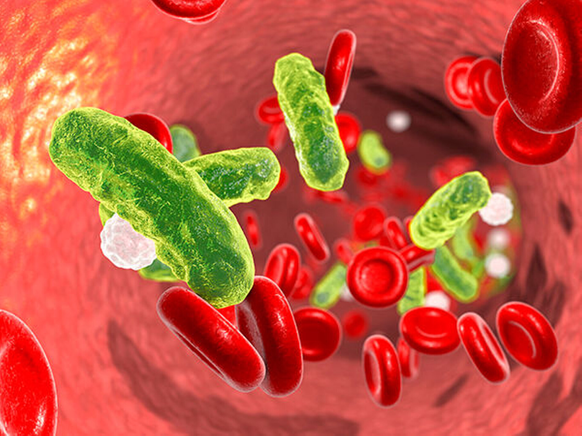 Sepsis eine der häufigsten Todesursachen bei Infektionen