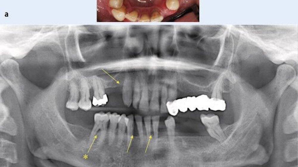 Abbildung 1:\r\na) Generalisierte fortgeschrittene Parodontitis bei einem Patienten mit Diabetes mellitus Typ 2: Intraorale klinische Situation bei der Erstunter suchung: Rötungen und Schwellungen der Gingiva im Ober- und Unterkiefer hervorgerufen durch