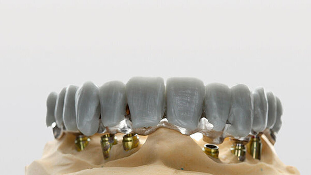 Wax-up frontal