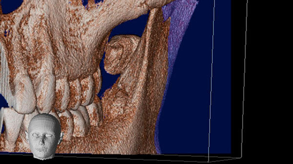 Abbildung 3: In der 3-D-Rekonstruktion der DVT lässt sich die genaue Lage des Zahns verifizieren.