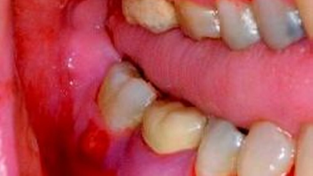 Abbildung 1a: intraoraler Befund: Fistelbildung im Bereich der attached Gingiva vestibulär des asensiblen Zahnes 47 (Testung mit Kohlendioxidschnee) mit Pusaustritt bei Kompression
