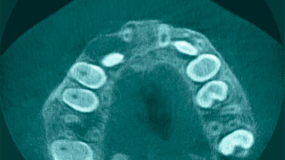 Abbildung 3a: DVT in axialer Schichtung: Es ist eine um den retinierten Zahn 13 befindliche Aufhellung zu erkennen, die sich vor allem nach vestibulär erstreckt. Im Bereich des vestibulären Knochens ist bereits eine Kontinuitätsunterbrechung zu beobachten. Die Ausdehnung lässt sich in der coronaren Rekonstruktion (Abbildung 3b) gut nachvollziehen. |