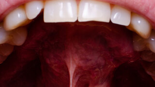 A tumor in the oral cavity of an adult, close-up. dental problems.