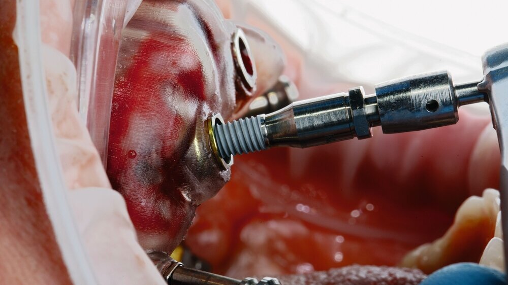 Insertion eines Implantats mittels Schablone Insertion eines Implantats mittels Schablone