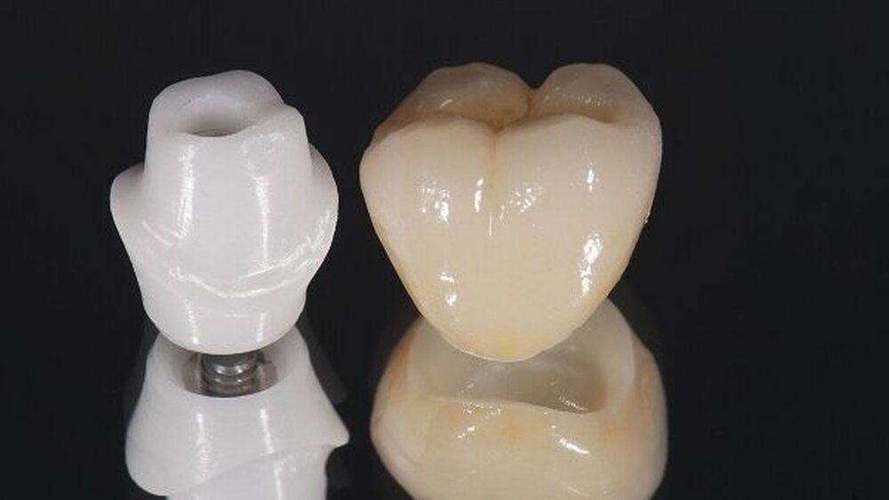 Abbildung 2: ZrO2-Abutments für Implantat-Molarenkronen zeigen eine gute Überlebensprognose. |