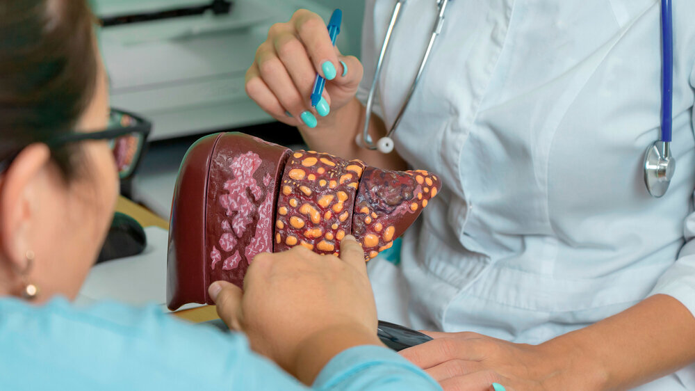 patient at doctor's appointment points to the model of the liver. doctor talks about the 4 stages of development of cirrhosis. the patient at the doctor's appointment points to the model of the liver. the doctor talks about the 4 stages of development of cirrhosis.