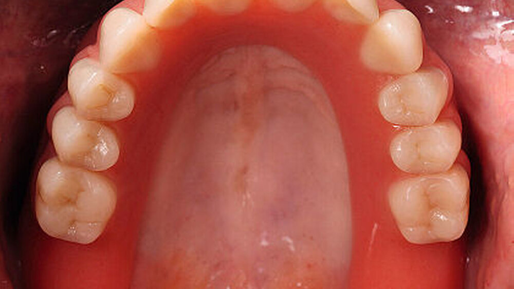 Abbildung 8 und 9: Im Oberkiefer wurden sechs Implantate mit Teleskopen versorgt. Hier wurde das Konzept des „Passive-Fit“ mithilfe der Galvanoteleskope realisiert. |